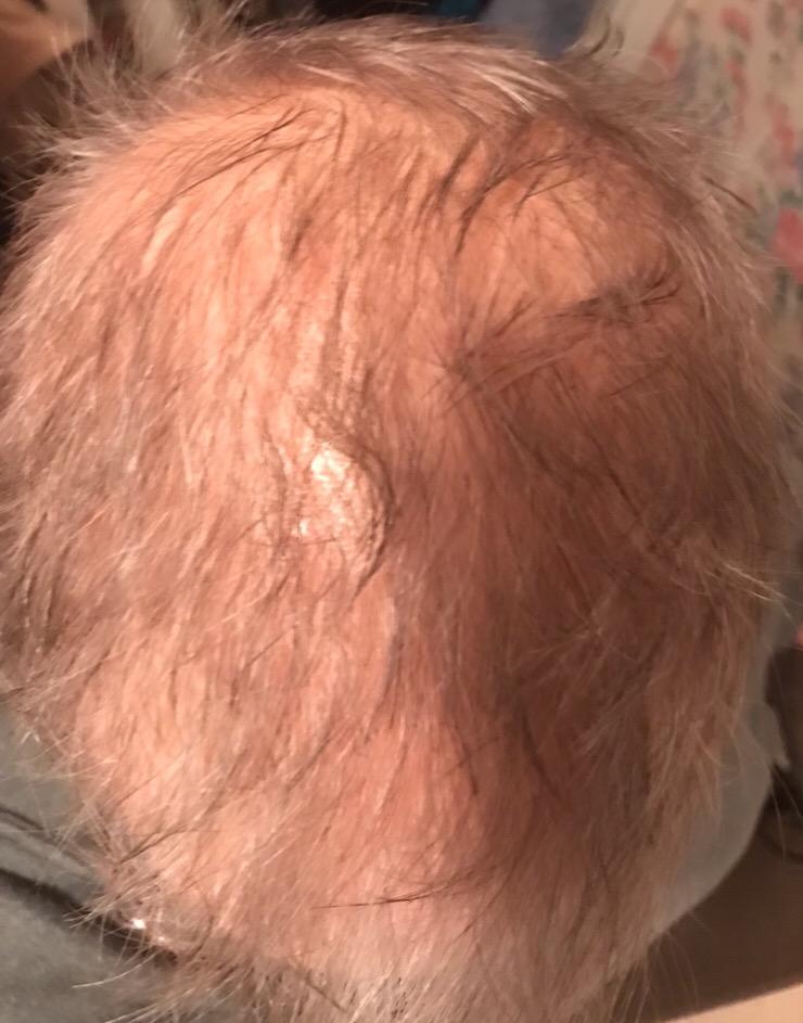 iRestore Essential - Laser Red Light Therapy for Hair Growth - FDA Cleared Hair Loss, Hair Thinning & Alopecia Treatment for Men & Women - Laser Cap for Hair Regrowth Stimulate Denser Fuller Hair customer photo 2