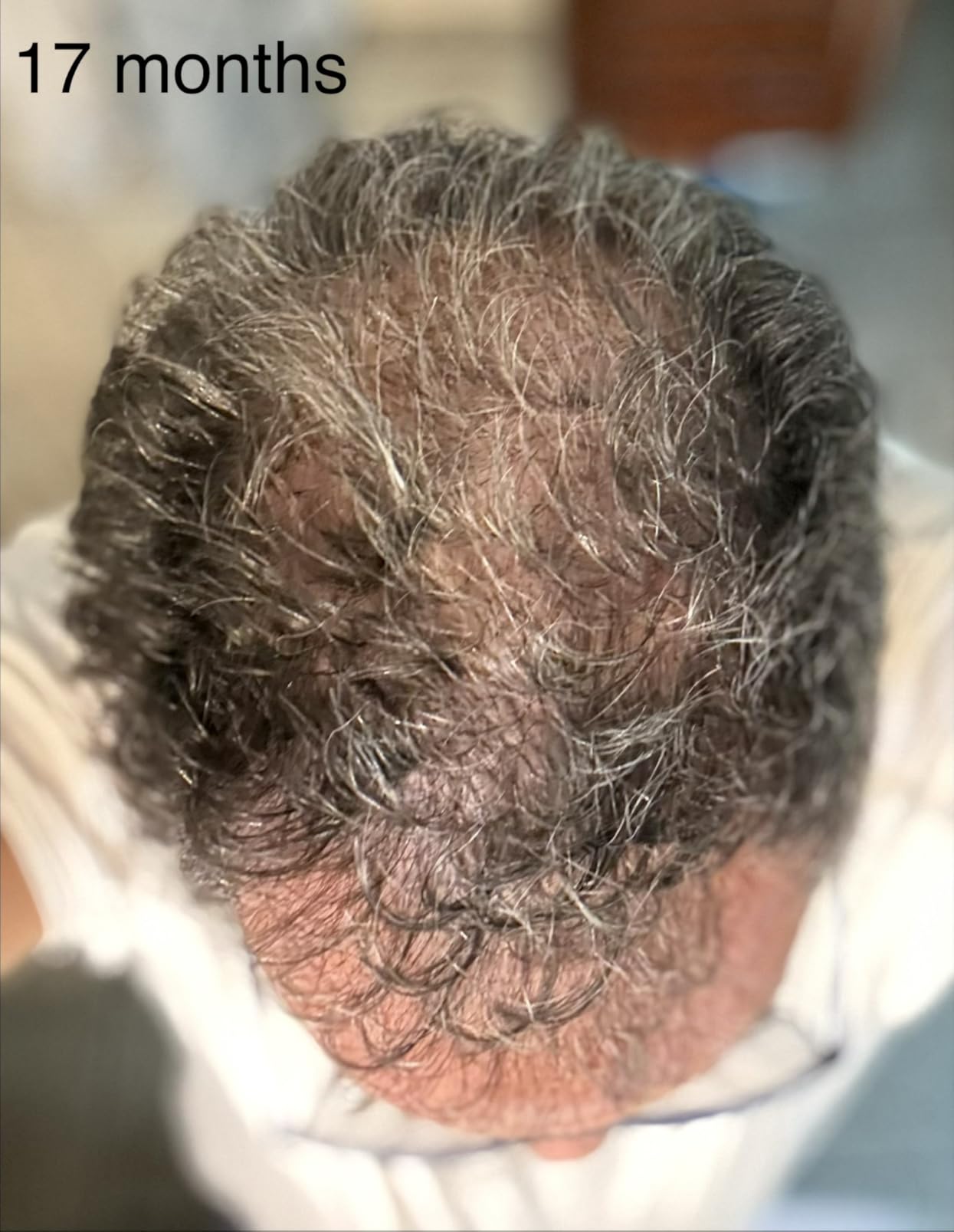 iRestore Professional Laser Red Light Therapy for Hair Growth System - FDA Cleared Hair Loss, Hair Thinning & Alopecia Treatment for Men & Women - 282 Lasers & LEDs customer photo 1