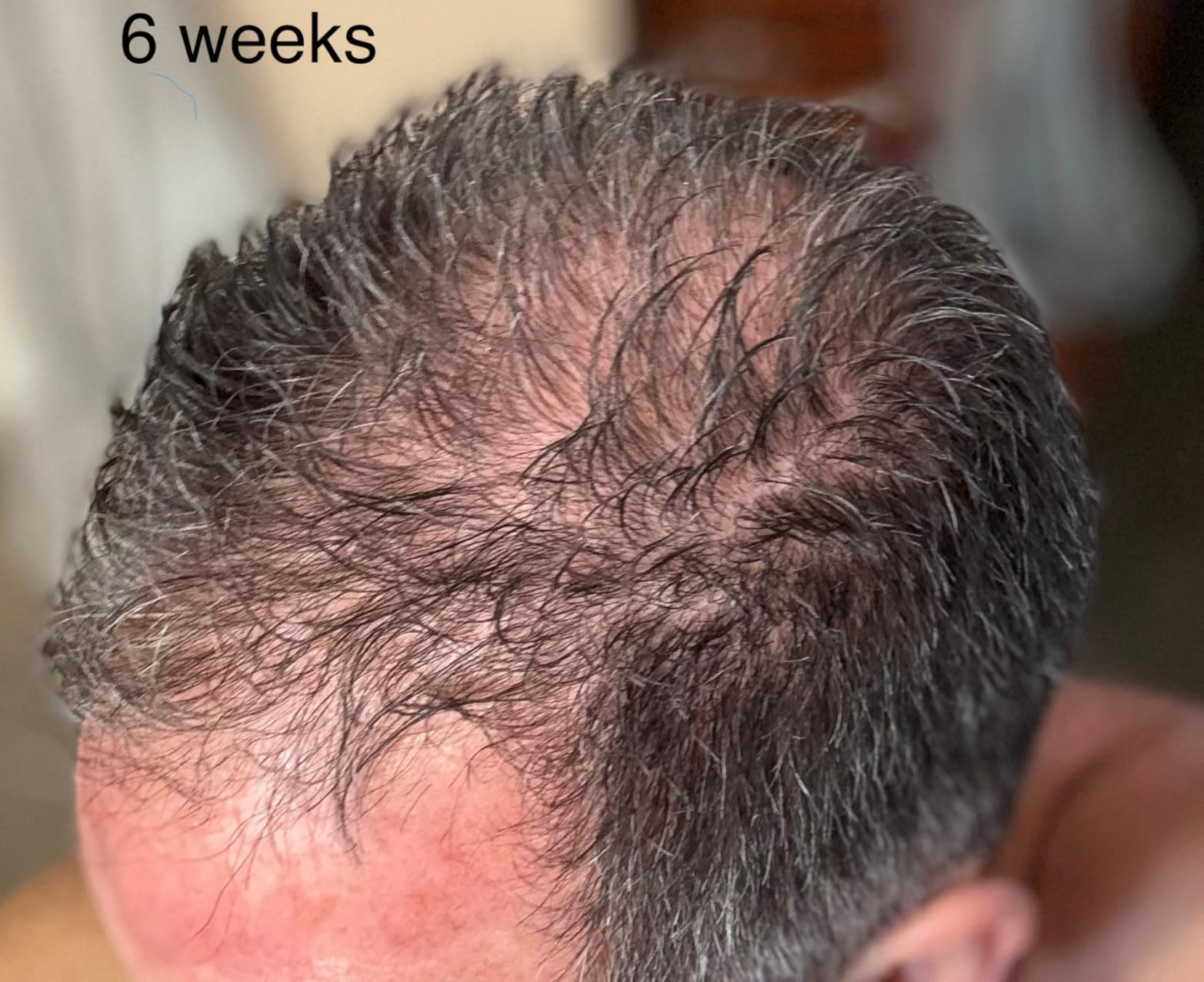 iRestore Professional Laser Red Light Therapy for Hair Growth System - FDA Cleared Hair Loss, Hair Thinning & Alopecia Treatment for Men & Women - 282 Lasers & LEDs customer photo 2
